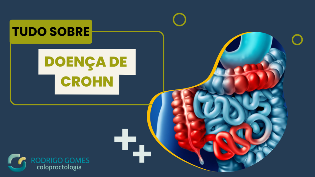 Tudo o que você precisa saber sobre a doença de Crohn