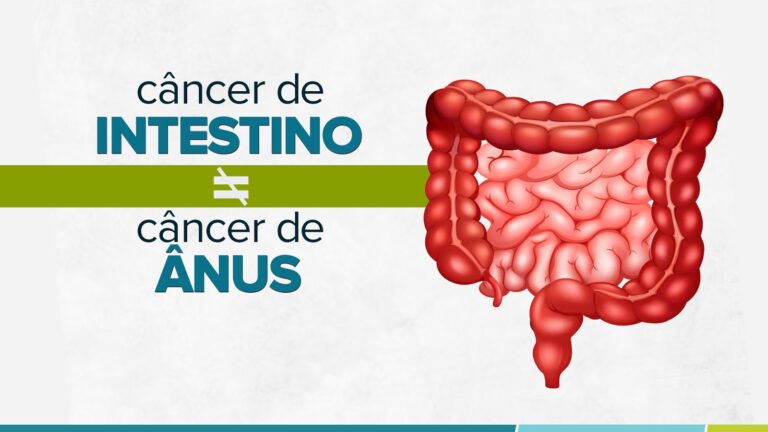 Entenda As Diferenças Entre O Câncer De Intestino E O Câncer De ânus Dr Rodrigo Gomes 7119