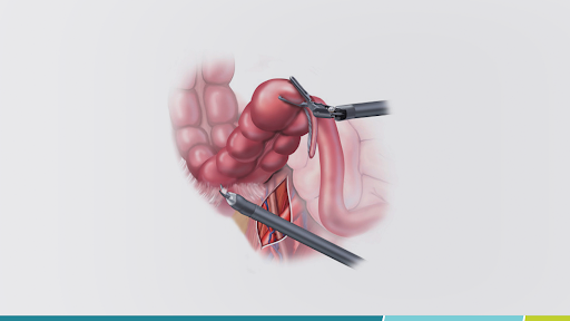 Saiba como é o pós-operatório da cirurgia robótica de intestino