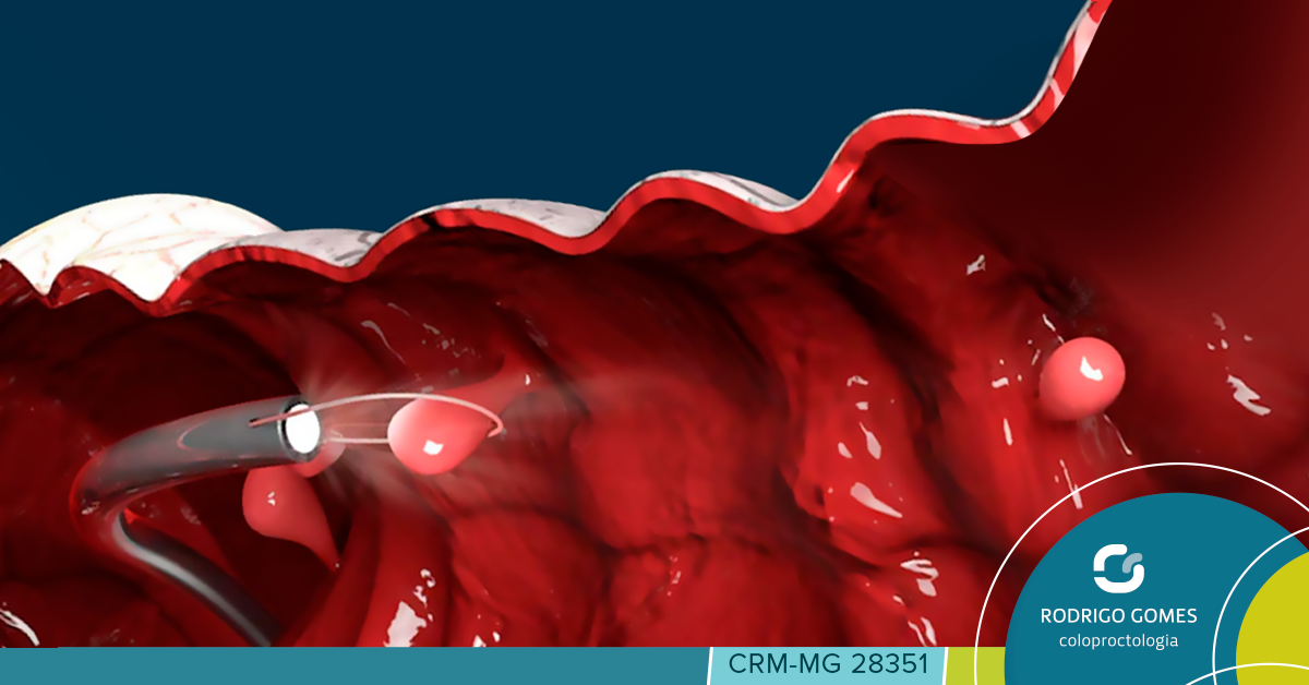 Retossigmoidoscopia e Colonoscopia: entenda a diferença entre esses exames