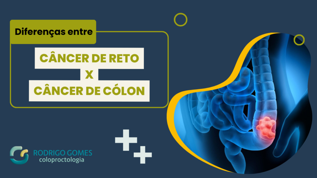 Diferença Entre Câncer de Reto e Câncer de Cólon - Dr. Rodrigo Gomes