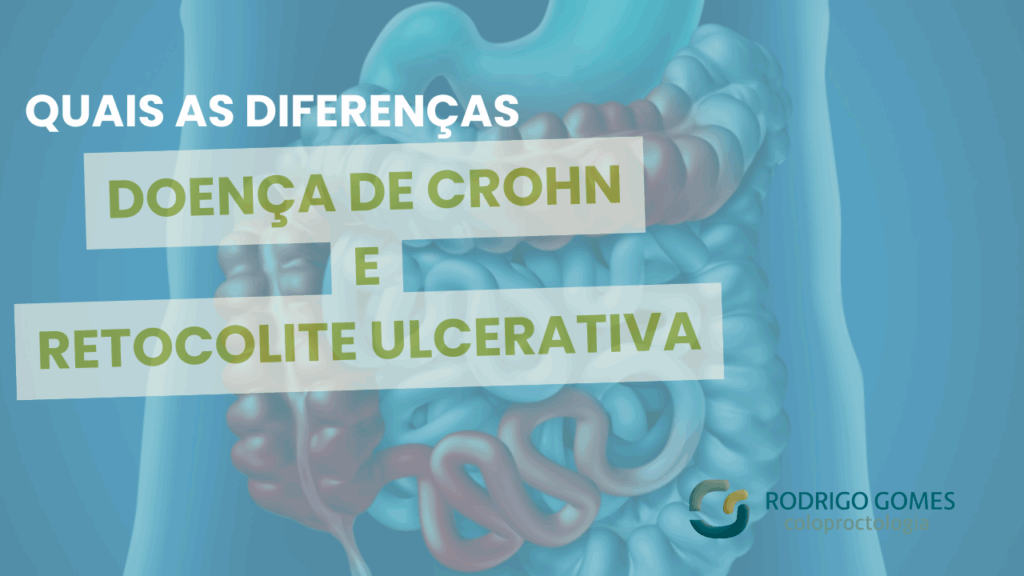 Doença de Crohn e Retocolite Ulcerativa quais as diferenças e como tratar