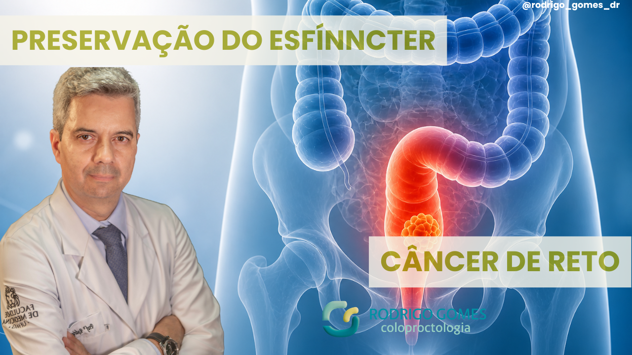 Preservação do esfíncter no câncer de reto e os impactos na qualidade de vida do paciente